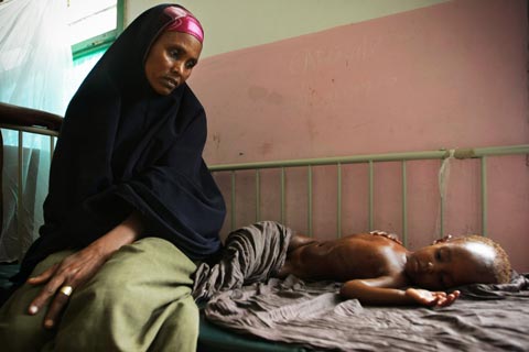 A mother looks at her malnourished and dehydrated child lying on a bed in Banadir Hospital in the Somali capital Mogadishu