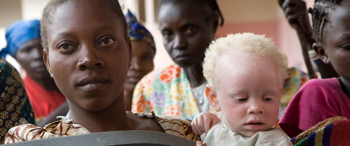 Madre con niño con albinismo. Foto ONU/Marie Frechon