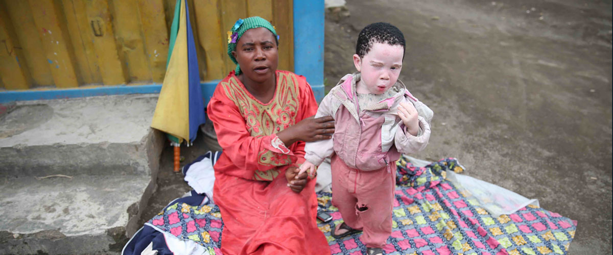 Madre con un niño con albinismo, República Democrática del Congo. Foto ONU/Abel Kavanagh