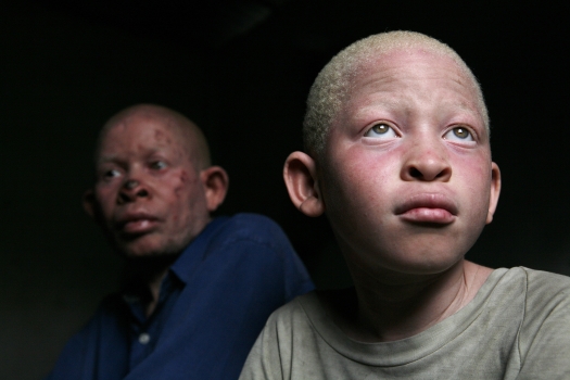 A child living with albinism and his father in Dar es Salaam, Tanzania. Photo: Panos/ Dieter Telemans