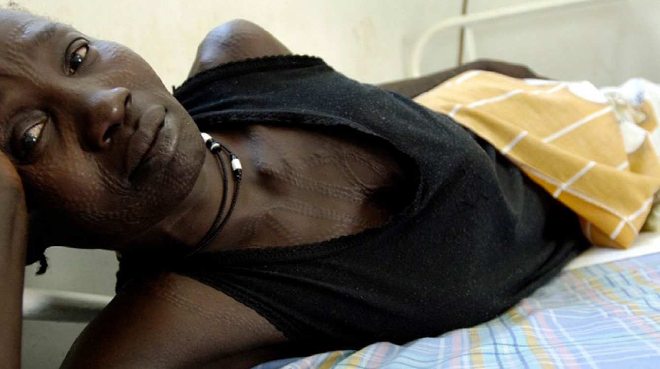 Une patiente souffrant d’une fistule obstétricale, l’une des lésions les plus graves et dangereuses susceptibles de survenir lors d’un accouchement. Photo ONU/Tim McKulka