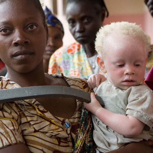 Madre con niño con albinismo. Foto ONU/Marie Frechon