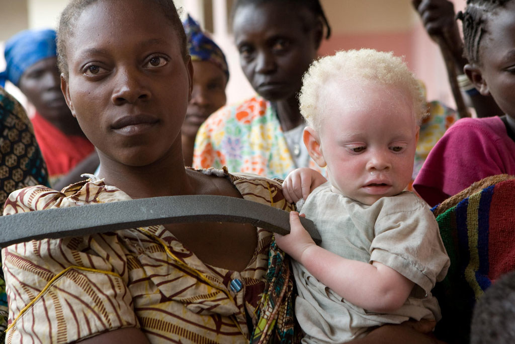 woman holding child with albinism