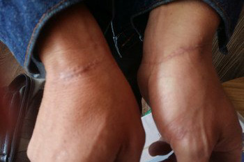 Scars on a person’s both wrists