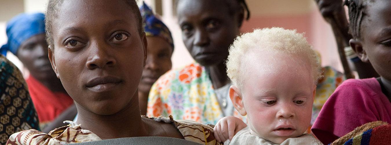 Primer plano de una mujer con un niño albino en brazos.