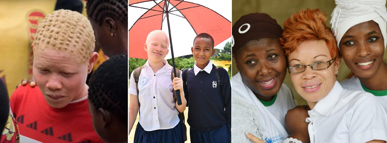 3 fotos. 1: un joven con albinismo entre una multitud de personas de piel más oscura. 2: dos niños, uno tiene albinismo y el otro es de piel oscura. 3: tres mujeres adultas una de ellas es albina.