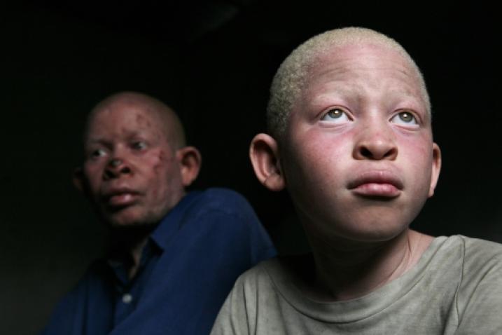 portrait of a child living with albinism and his father