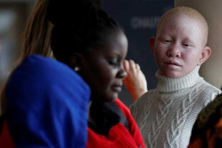 A young person with albinism looks to the side with a pained expression