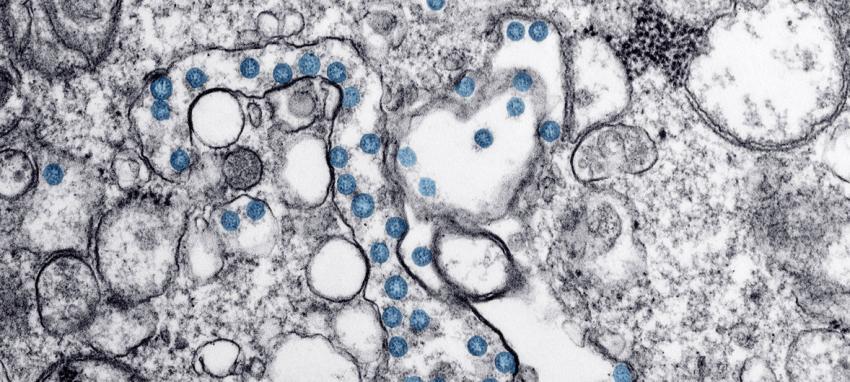 Image prise en microscope d'une infection au coronavirus (en bleu) sur le premier cas découvert aux Etats-Unis .