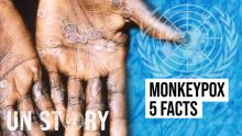 Monkeypox - What you Should Know