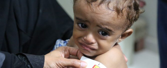 Niño recibiendo tratamiento para la desnutrición aguda en un hospital de Hajjah, en Yemen. Foto: PMA/Abeer Etefa.