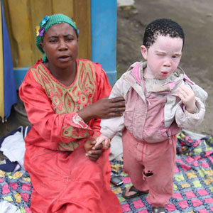 刚果共和国的一位母亲和她患有白化病的孩子。联合国图片/Abel Kavanagh